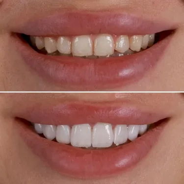 Hollywood Smile