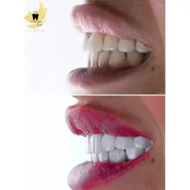 Veneers (Hollywood Smile)