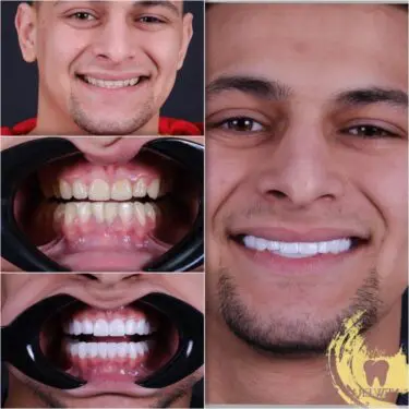 Veneers (Hollywood Smile)