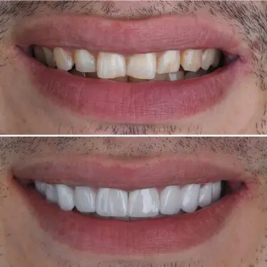 Veneers in Antalya