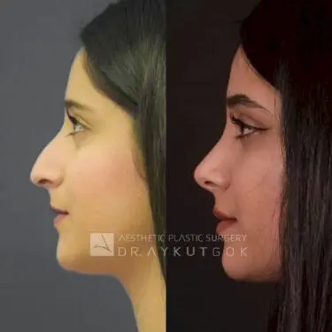 Rhinoplastik