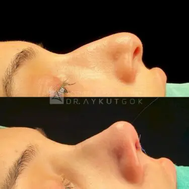 Rhinoplastik