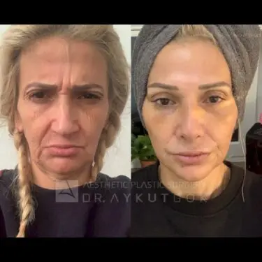 Gesichtsstraffung