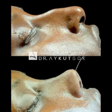 Rhinoplastik