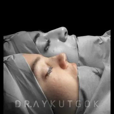 Rhinoplastik