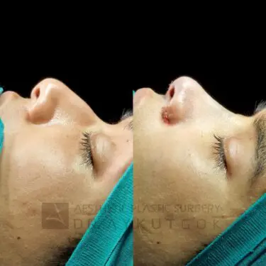 Rhinoplastik