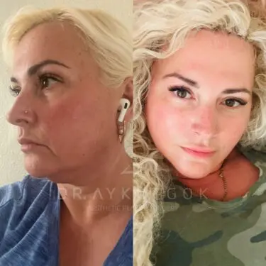 Gesichtsstraffung