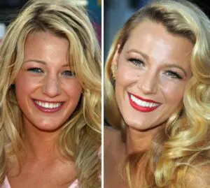 Teeth Turkey Antalya 