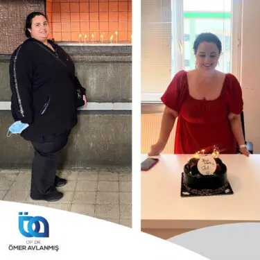 Chirurgie bariatrique (bypass gastrique)