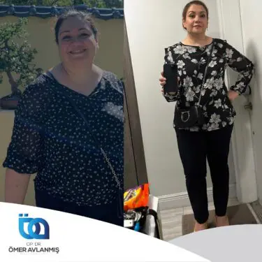 Chirurgie bariatrique (bypass gastrique)