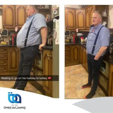 Chirurgie bariatrique (bypass gastrique)