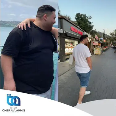 Chirurgie bariatrique (bypass gastrique)