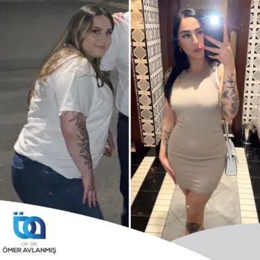 Chirurgie bariatrique (bypass gastrique)