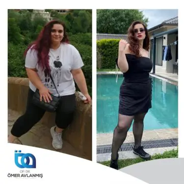 Chirurgie bariatrique (bypass gastrique)