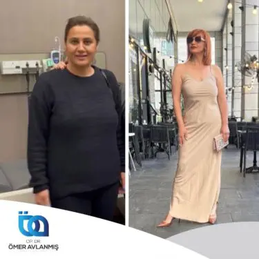 Chirurgie bariatrique (bypass gastrique)