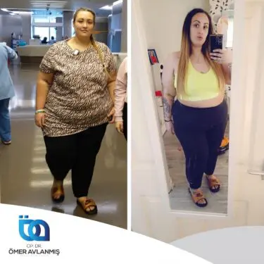 Chirurgie bariatrique (bypass gastrique)