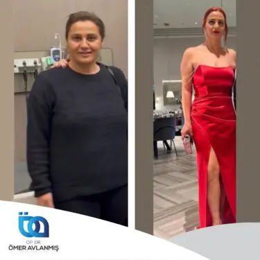 Chirurgie bariatrique (bypass gastrique)