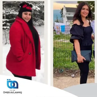 Chirurgie bariatrique (bypass gastrique)