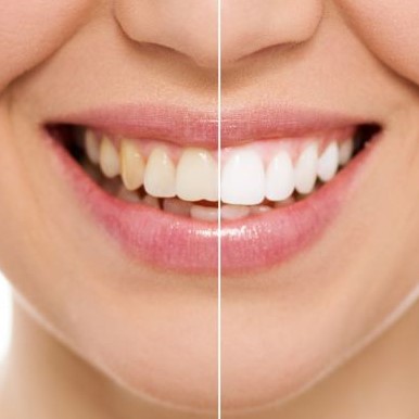 Отбеливание зубов