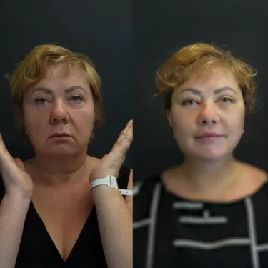 Лифтинг лица