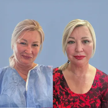 Лифтинг лица