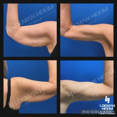 Лифтинг рук