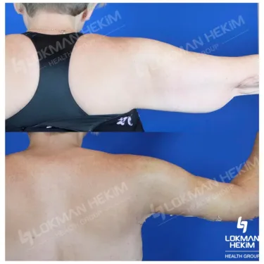 Лифтинг рук