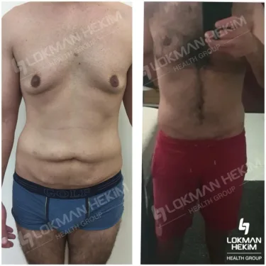 Подтяжка живота