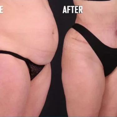 Abdominoplasty