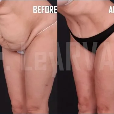 Abdominoplasty