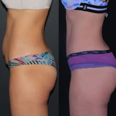 Liposuction 