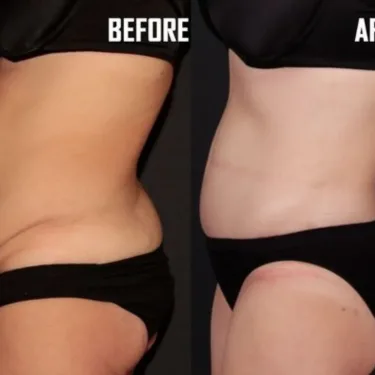 Липосакция