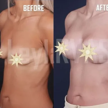 Breast augmentation