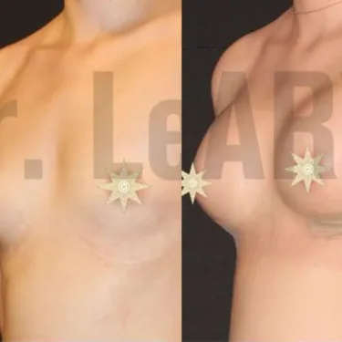 Breast augmentation