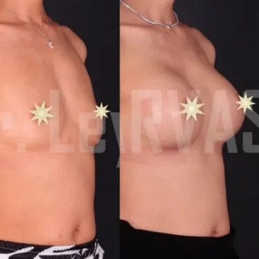Breast augmentation