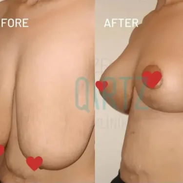 Breast reduction