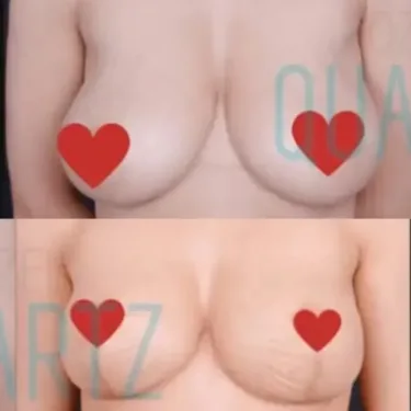 Breast reduction