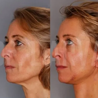 Face and neck lift
