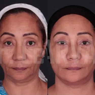 Face and neck lift