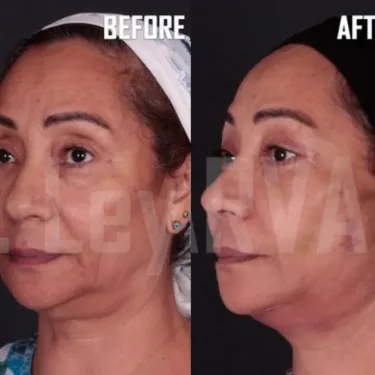 Face and neck lift