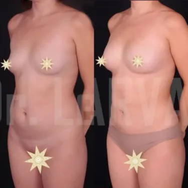 Липосакция