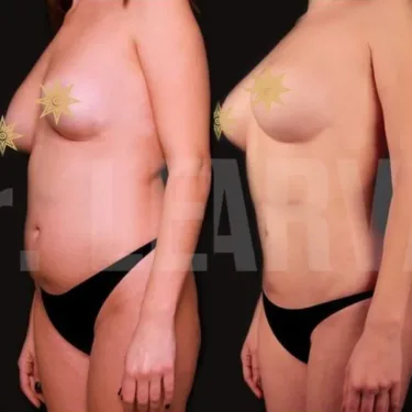 Липосакция