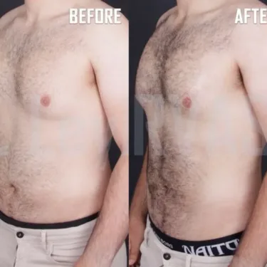 Vaser-липосакция