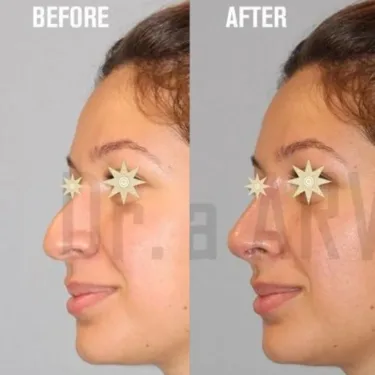 Rhinoplasty