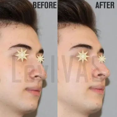 Rhinoplasty