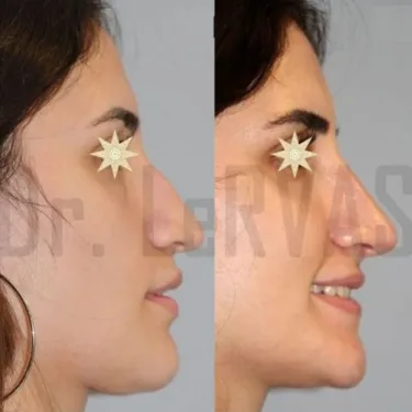Rhinoplasty