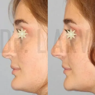Rhinoplasty
