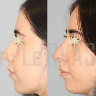 Rhinoplasty