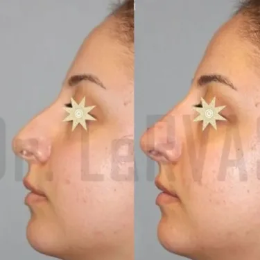 Rhinoplasty