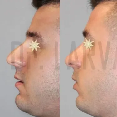 Rhinoplasty
